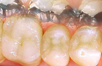 Zahnfüllungen an erkrankten Zähnen