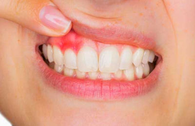 Gingivitis Entzündungen des Zahnfleischs